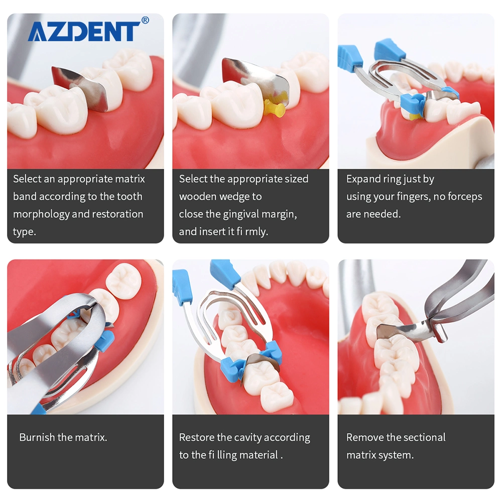 Hot Sale Azdent Dental Sectional Contoured Matrix Clip Matrices Clamps Wedges