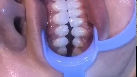 Dental Material Plastic Blue Cheek Retractor